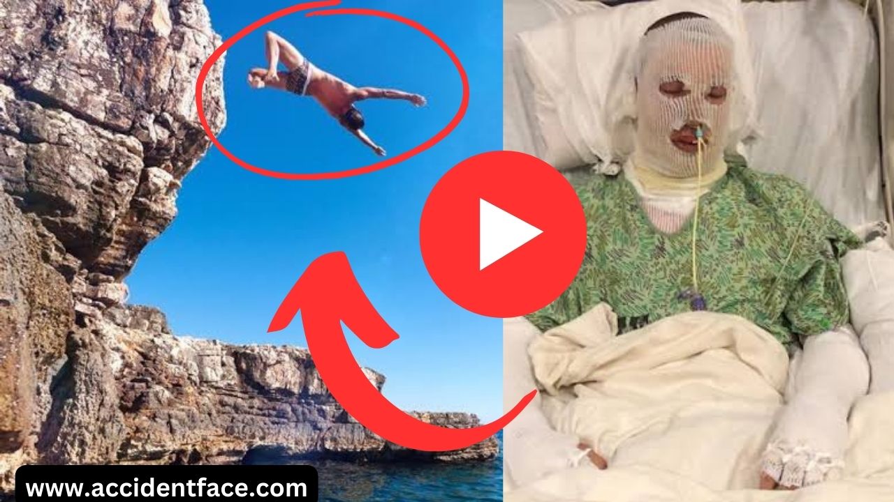Split face diving accident face